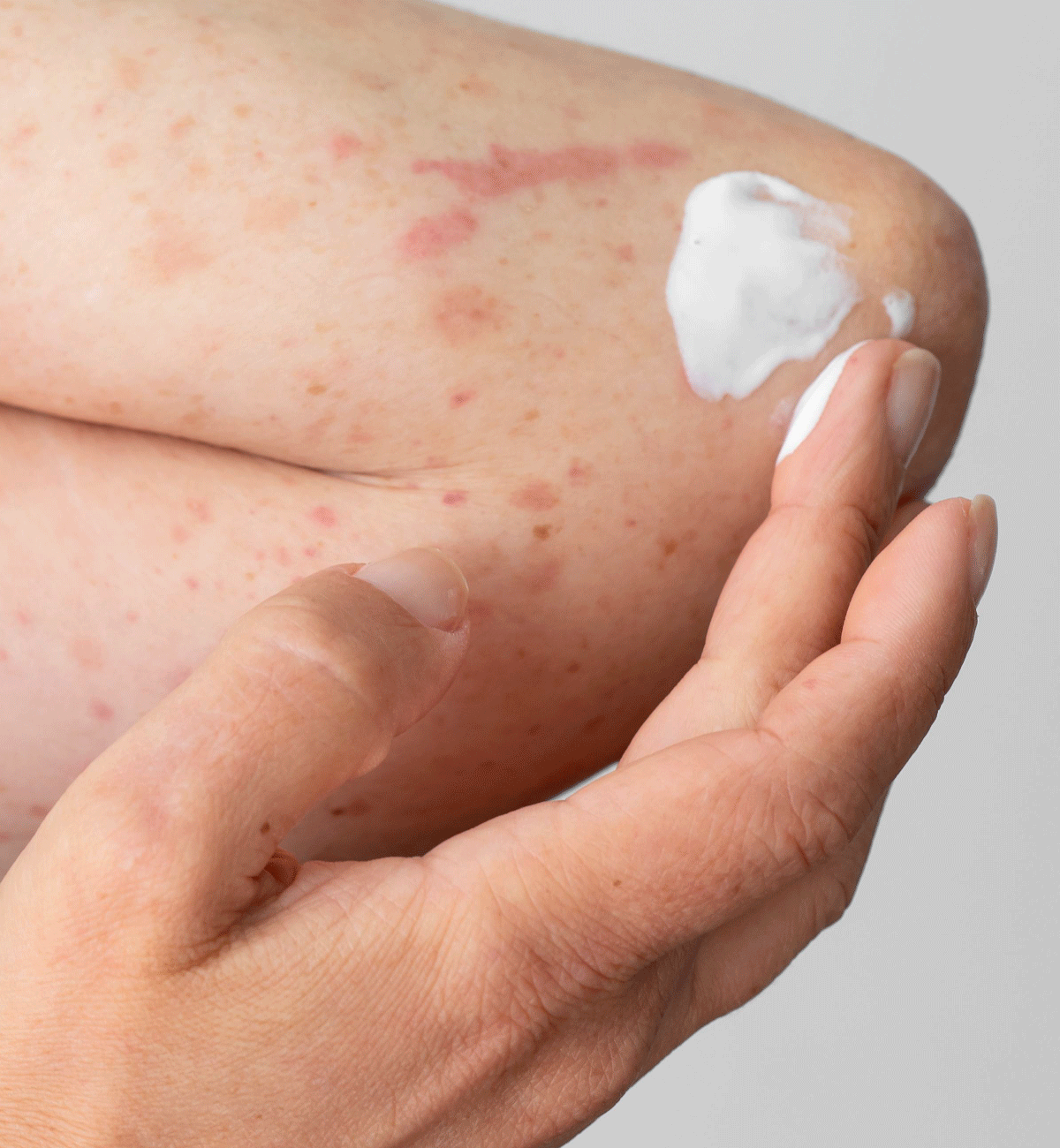 Use Derma Repair cream on cracked, eczema and psoraisis skin.